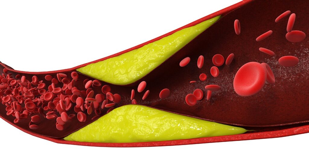 Narrowed artery with plaque buildup (yellow) and red blood cells flowing through, representing atherosclerosis or blocked blood vessels.