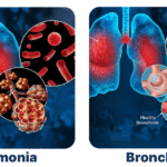 Infographic showing the difference between pneumonia and bronchitis, highlighting their key features and classifications.