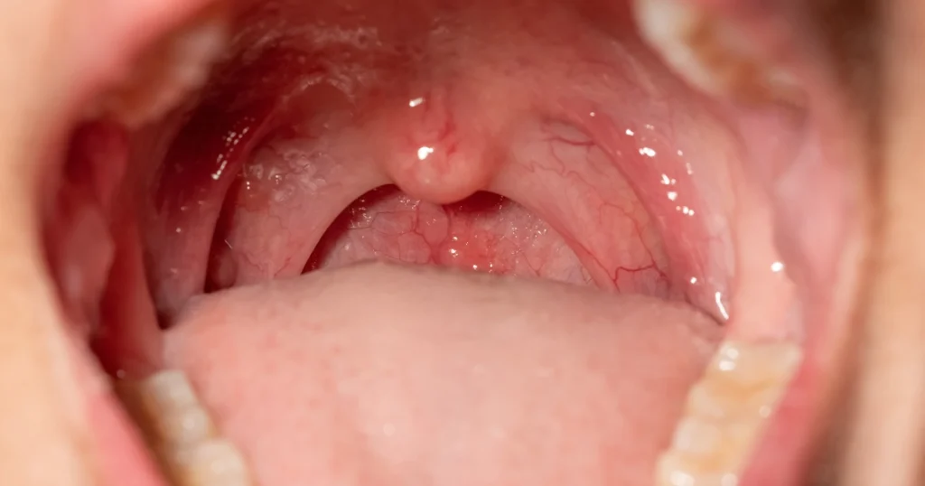 Red inflamed throat showing possible strep throat symptoms.