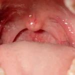 Red inflamed throat showing possible strep throat symptoms.