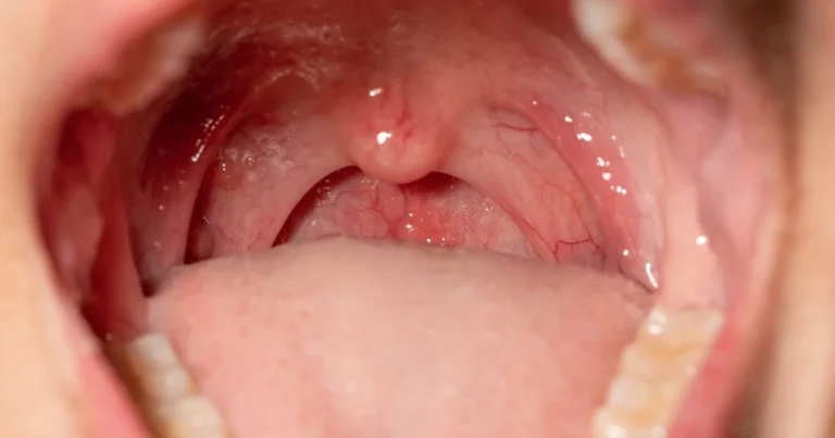 How Contagious Is Strep Throat