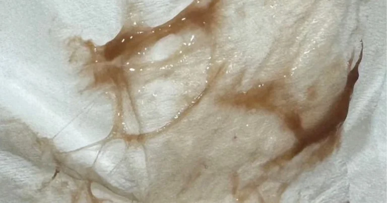 Why Is My Mucus Brown