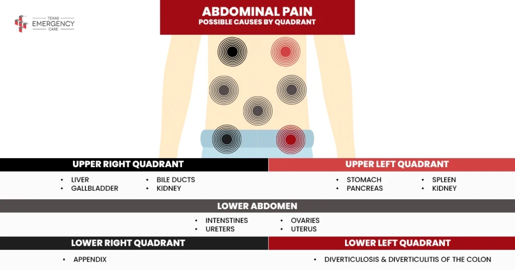 Abdominal pain diagram showing possible causes by stomach quadrant.