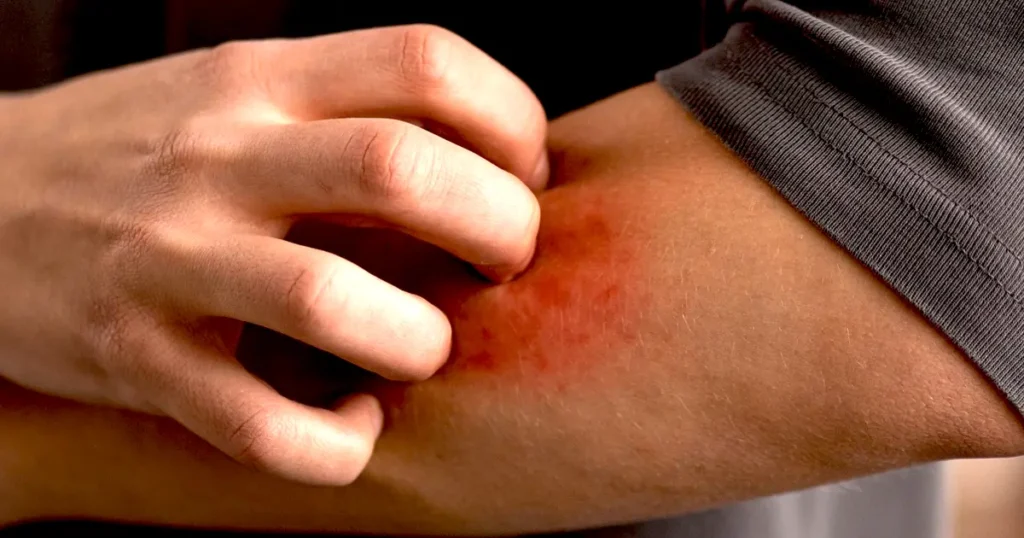 Close-up view of a person’s shoulder showing dry, red, and flaky skin patches, representing a skin condition like eczema, psoriasis, or a severe sunburn.