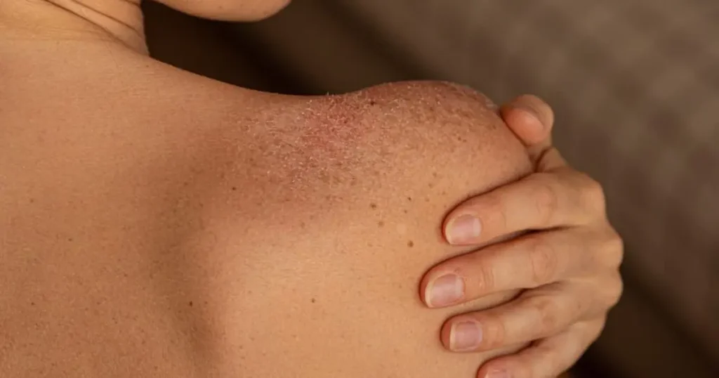 Close-up of a person scratching a red, inflamed rash on their arm, showing visible skin irritation.