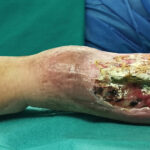 Severe arm wound with bone infection.