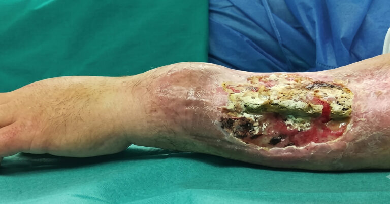 What Is Bone Infection?
